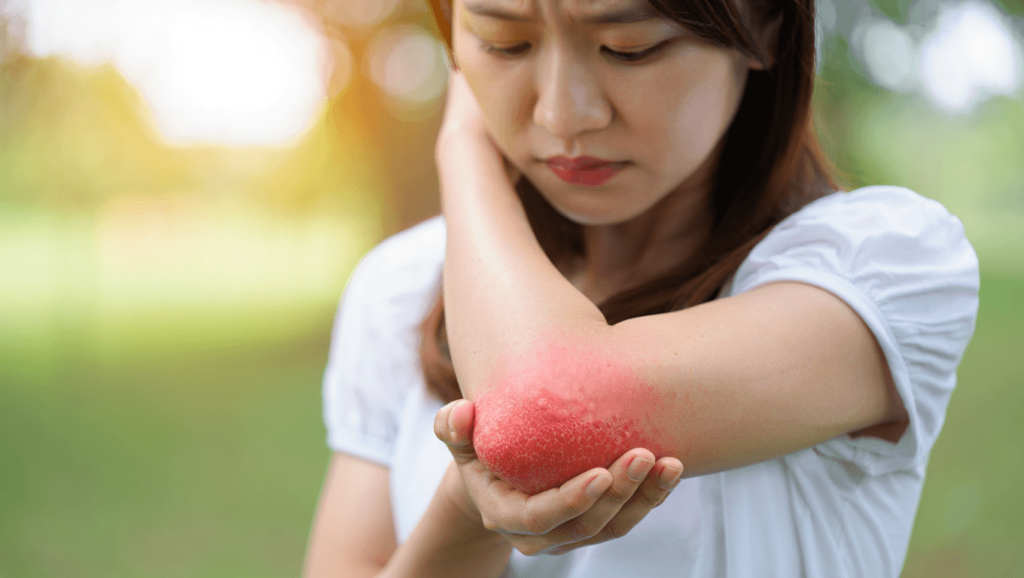 Le rôle du stress dans lʹaggravation de lʹeczéma