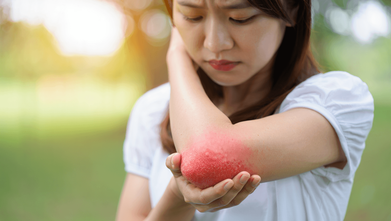 Le rôle du stress dans lʹaggravation de lʹeczéma