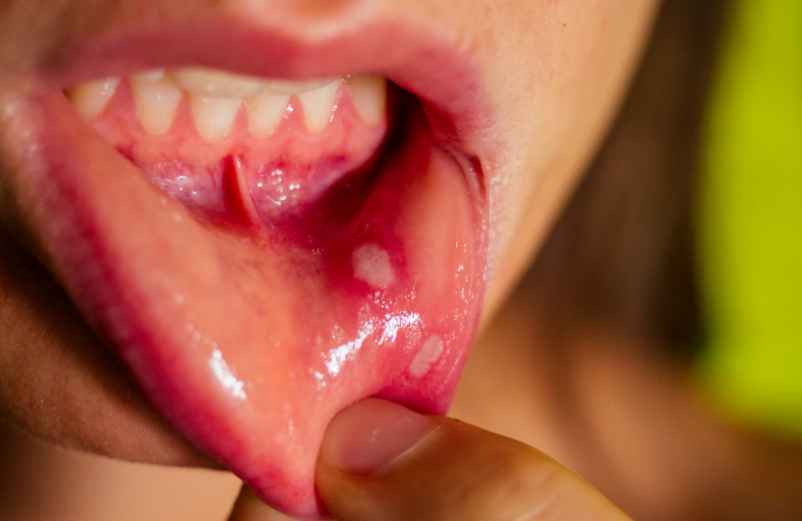 Comment réduire le risque de transmission ?-Santé AMU de France