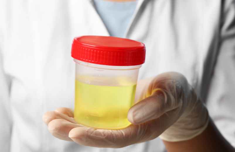 Qu’est-ce que l’hématurie chez la femme ?-Santé AMU de France Qu’est-ce que l’hématurie chez la femme ?-Santé AMU de France